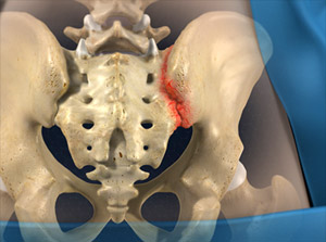 si joint injection